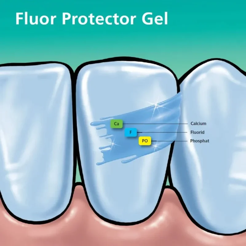 Ivoclar Fluor Protector (Pack Of 1) | Dental Product At Lowest Price