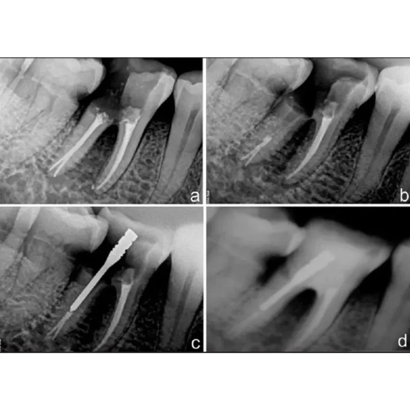 Prime Dental i Post Endodontic Metal Post Refills | Dental Product At Lowest Price