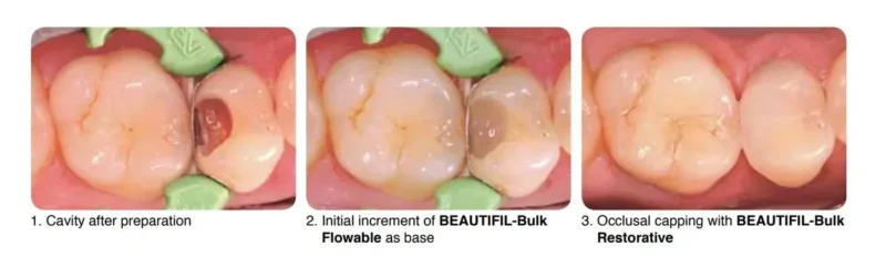 Shofu Beautifil Bulk Flowable Composite | Dental Product at Lowest Price