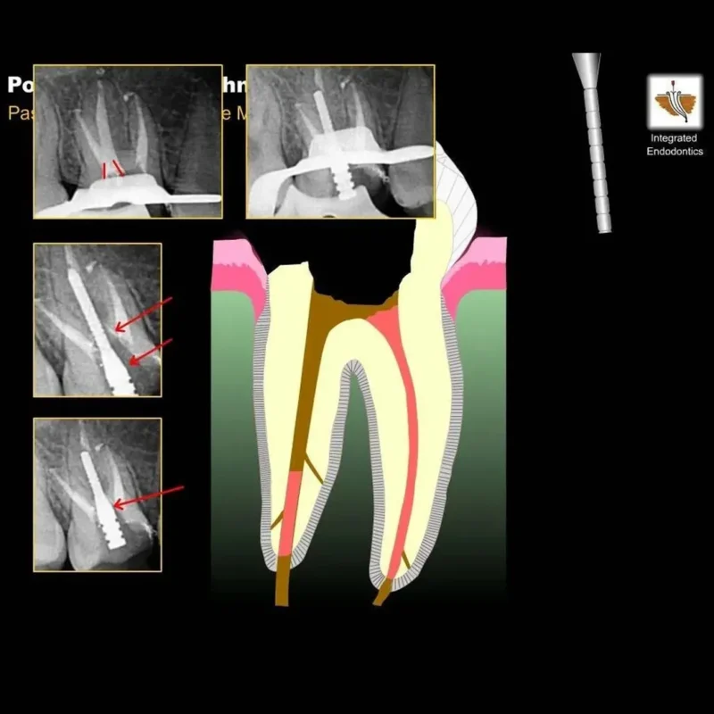 Prime Dental i Post Endodontic Metal Post Refills | Dental Product At Lowest Price