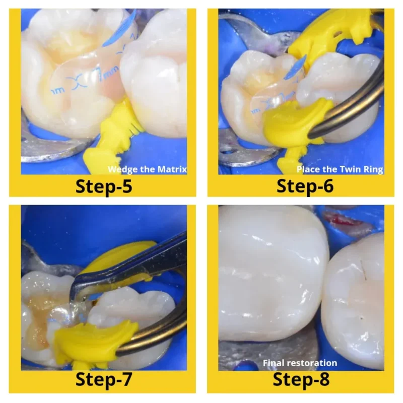 Bioclear Evolve Posterior Matrix Series | Dental Product at Lowest Price